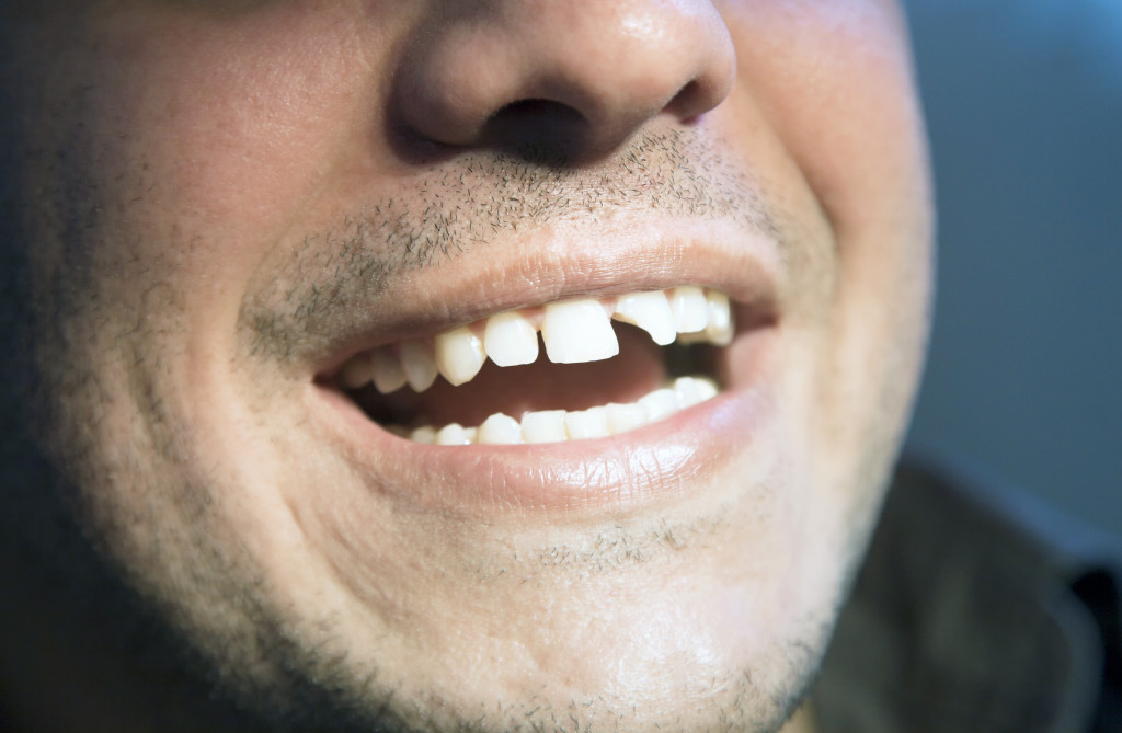 Closeup of a man's broken tooth