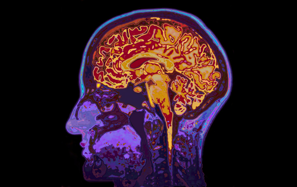 An MRI scan of the brain