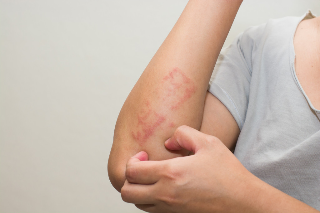 dermatitis or eczema on skin of female