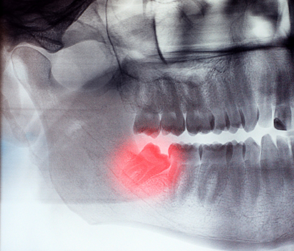 erupting wisdom tooth xray