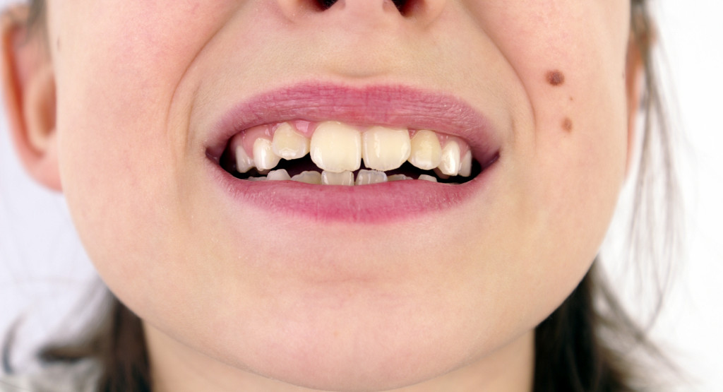 misaligned teeth