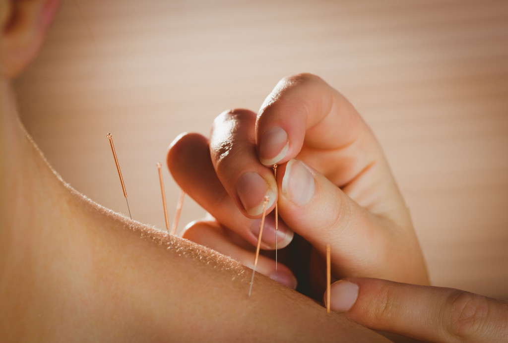 Person getting acupuncture treatment